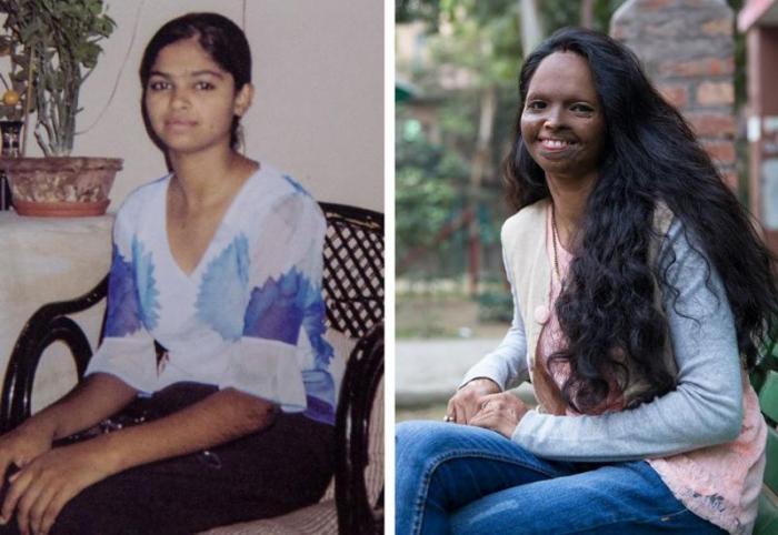 Success Story - Laxmi Agarwal Motivating Acid Attack Victims Relentlessly__Early Life