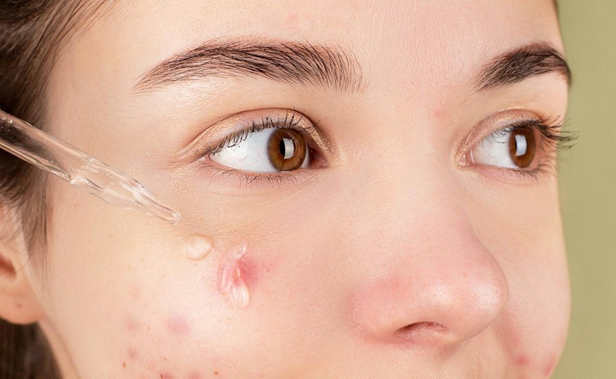 Review – The Ordinary Niacinamide – Does It Really Clear Acne__featured